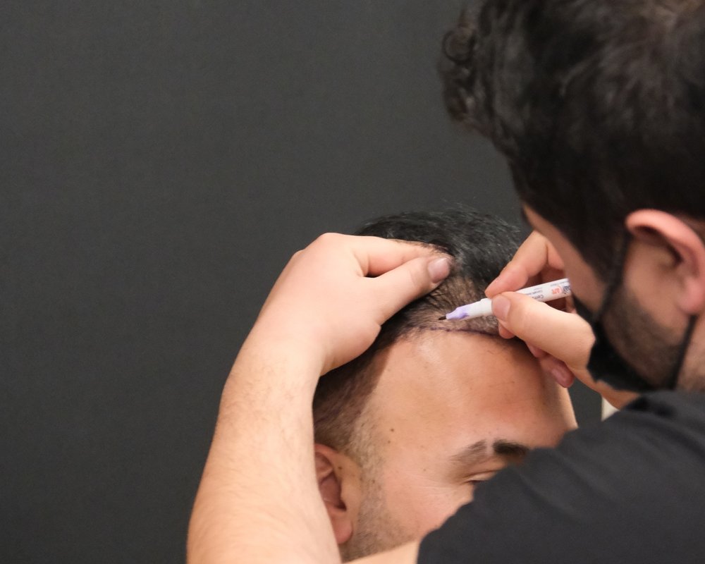 Hair,Transplant,Man,Women,Fue,Dhi,Sapphire,Hair,Care